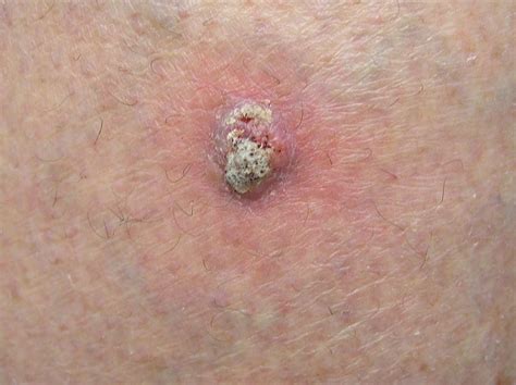 Skin with Merkel cell carcinoma