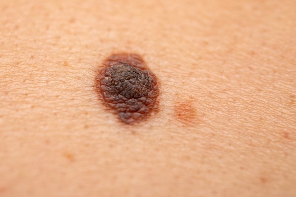 Close up of skin with melanoma