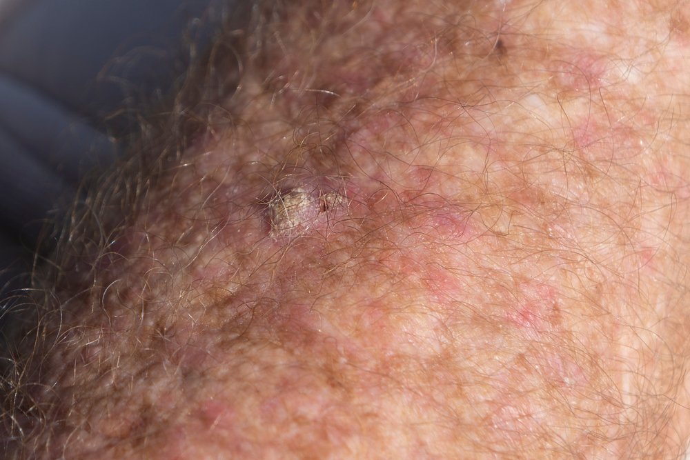 Skin with Squamous cell carcinoma