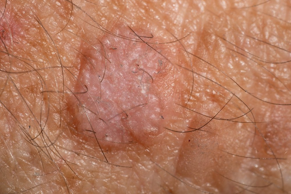 Close up of skin with Actinic Keratosis