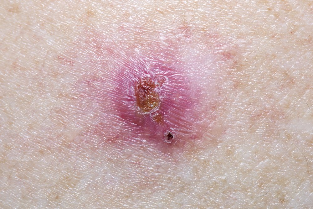 Close up of skin with Basal Cell Carcinoma