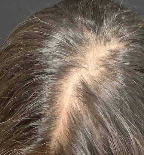 Hair Transplant: Follicular Unit Excision (FUE) - Finger Lakes